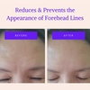 image:imageBLUMBODY Face Wrinkle Patches Complete Bundle Set for Face Smile Frown and Mini Wrinkle Lines