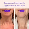 image:imageBLUMBODY Neck Chest and Smile Line Patches  Full Coverage Bundle