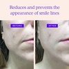 image:imageBLUMBODY Neck Chest and Smile Line Patches  Full Coverage Bundle